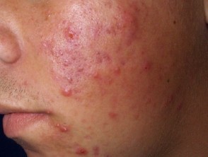 acnee-tratament-eximia